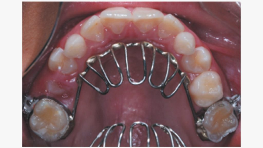 Thumb and Finger Sucking Procedures Dr Nkwana Dental